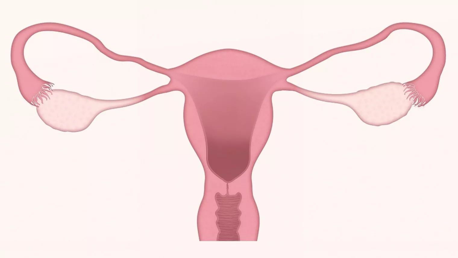 Ligasi Tuba, Pencegahan Kehamilan Secara Permanen