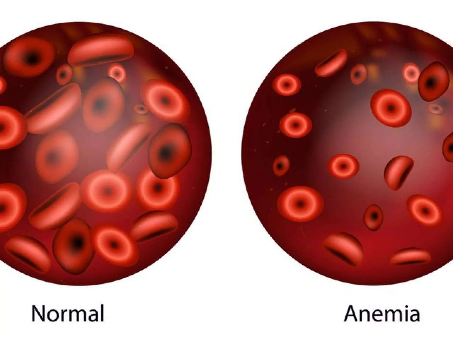 Kenali Anemia Defisiensi Besi: Penyebab, Gejala, dan Cara Mencegah