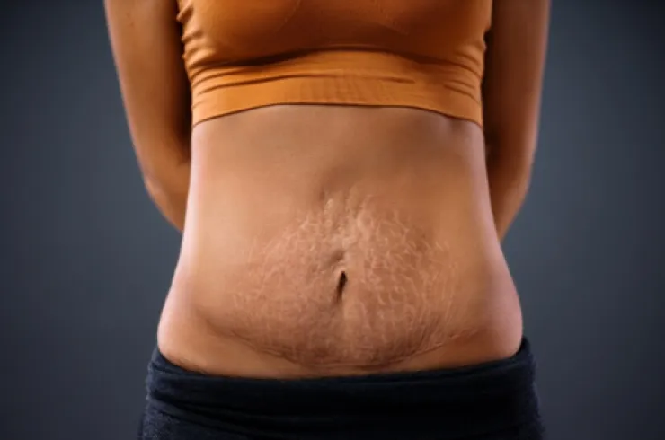 Tips dan Trik Mengatasi Stretch Mark Selama Kehamilan